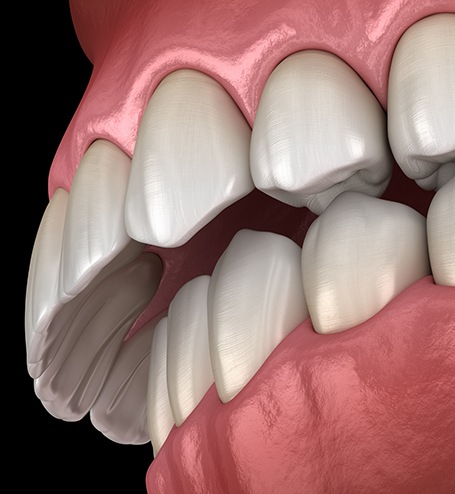 Patient holding up ClearCorrect aligners