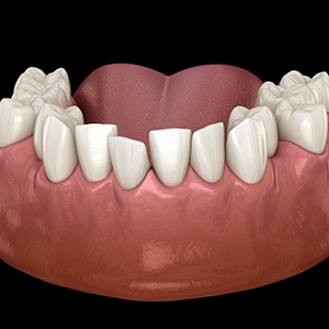 An illustration of gapped teeth before ClearCorrect treatment 