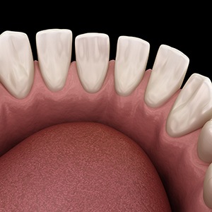 An illustration of a misaligned bite before ClearCorrect treatment 