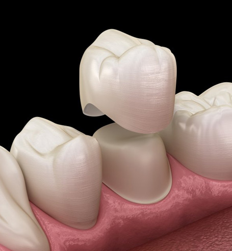 Exploded illustration of tooth and dental crown