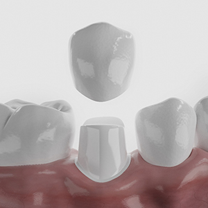 Digital image of a dental crown fitting over a tooth