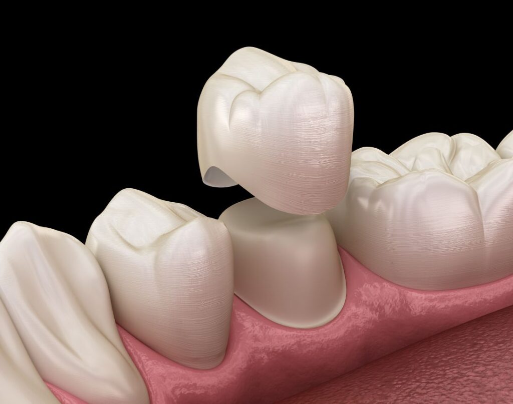 A CGI image of a dental crown